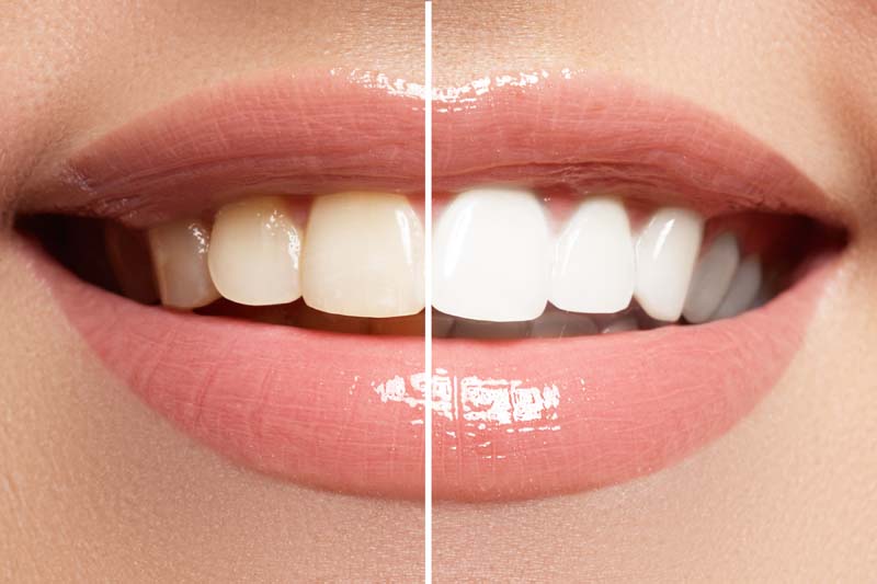 clareamento-dental clareamento-dental